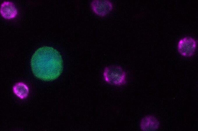 Zirkulierende Tumorzelle (CTC) aus Diagnostischer Leukapherese. Leukozytenmarker (CD45) in violett, Panzytokeratin in grün als Marker für CTCs, Kernfärbung in blau (DAPI). | Copyright: Lisa-Marie Rieckmann, DKFZ-Hector Krebsinstitut an der UMM 