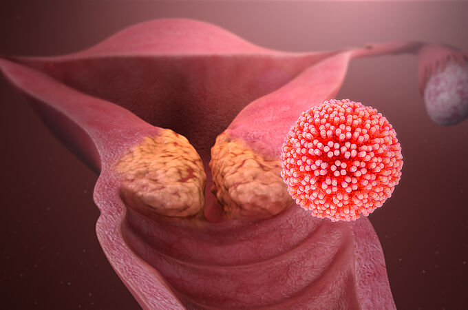 Durch HPV-Infektion kann ein Zervixkarzinom entstehen. Credits: Wikipedia/ CC BY-SA 4.0